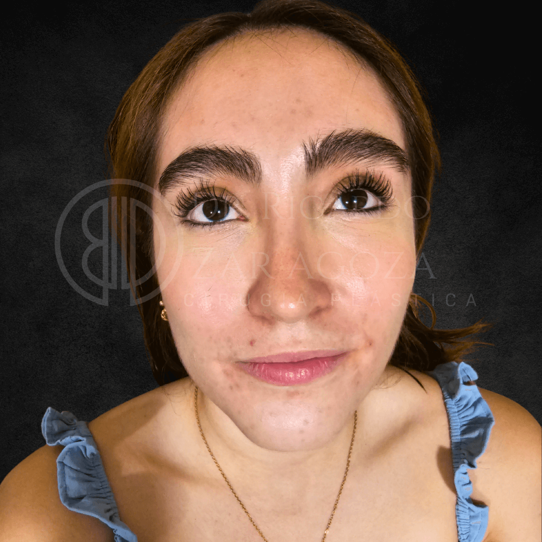 1 Relleno labios contorno acido hialuronico aumento antes precio 1