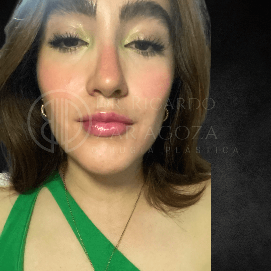 1 Relleno labios contorno acido hialuronico aumento resultados precio 1