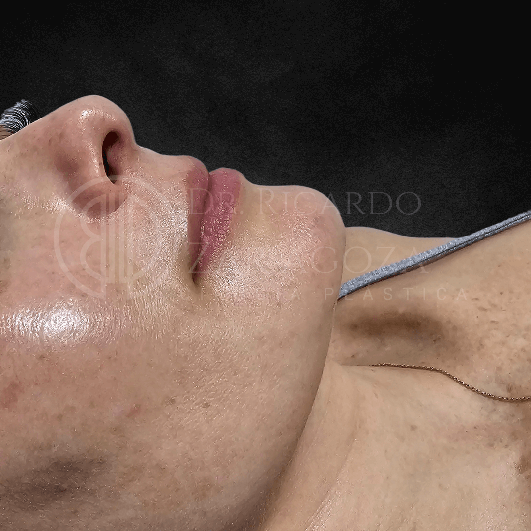 2 Relleno labios contorno acido hialuronico aumento antes precio 1