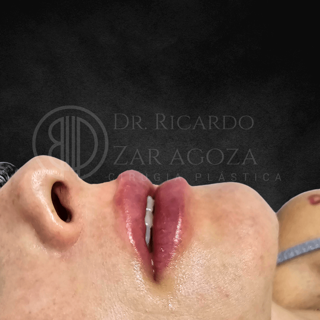 2 Relleno labios contorno acido hialuronico aumento resultados precio 1
