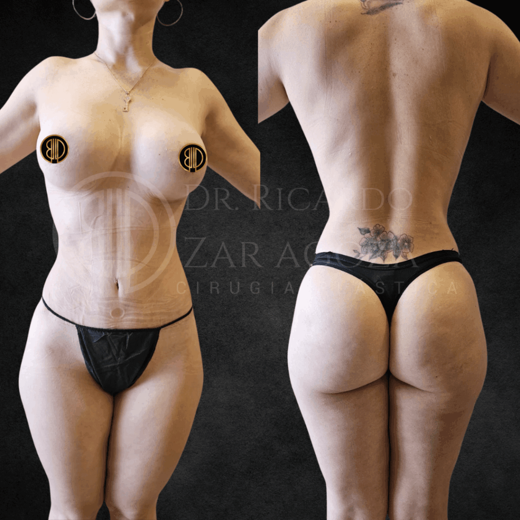 3 Mommy make over cirugia recuperar figura despues embarazo resultados