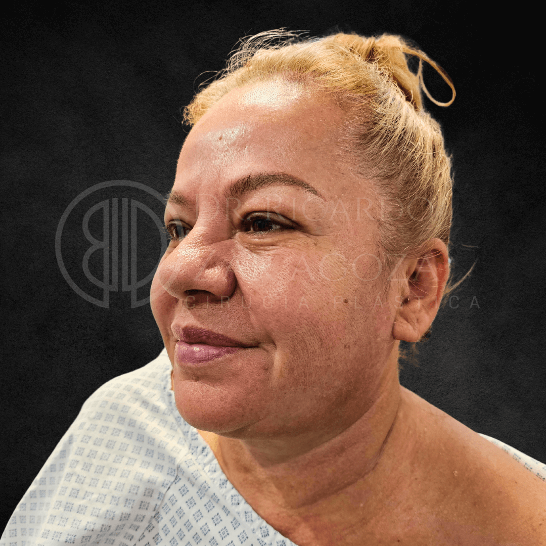 Blefaroplastia Morpheus 8 papados rejuvenecimiento piel hinchazon radiofecuencia antes 1