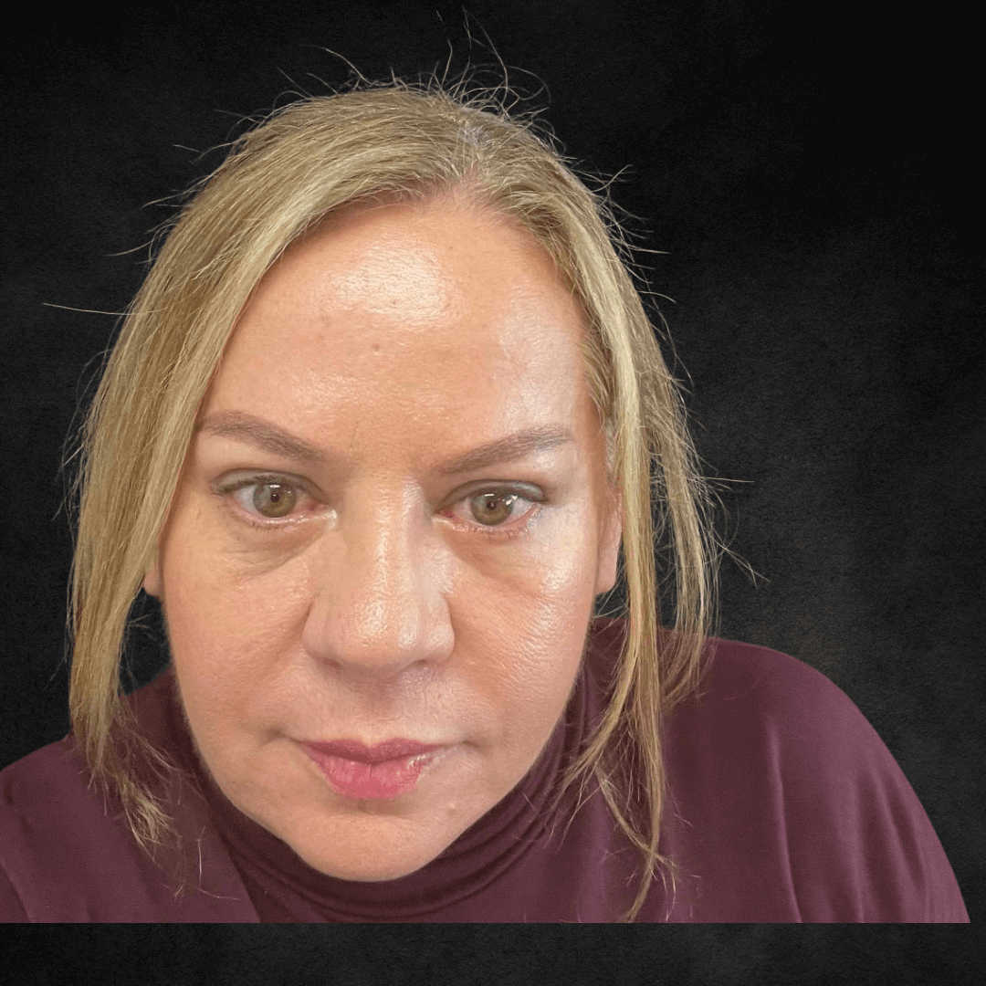 Blefaroplastia Morpheus 8 papados rejuvenecimiento piel hinchazon radiofecuencia resultados 1