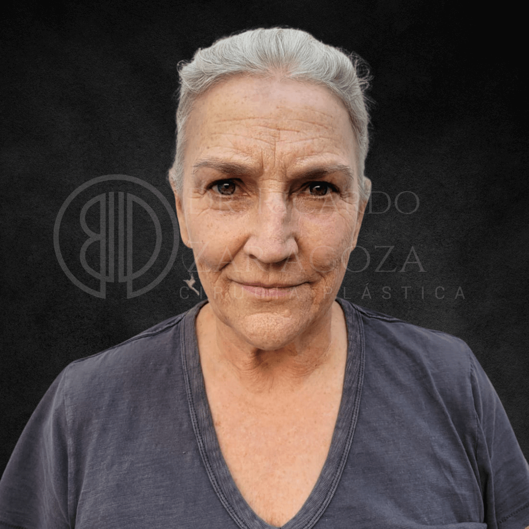 Lifting facial estiramiento cara cuello antes 1