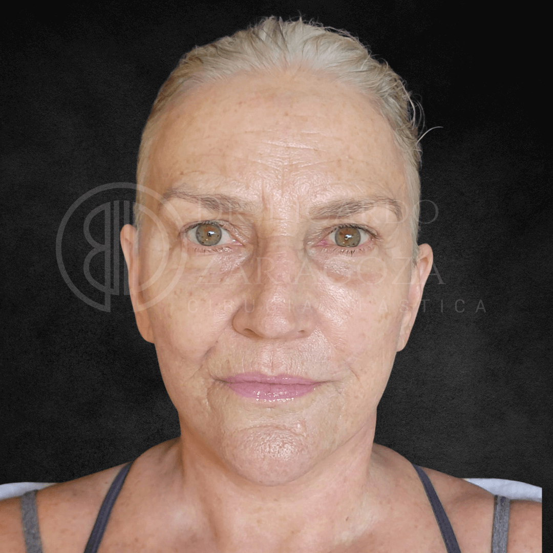 Lifting facial estiramiento cara cuello despues 1