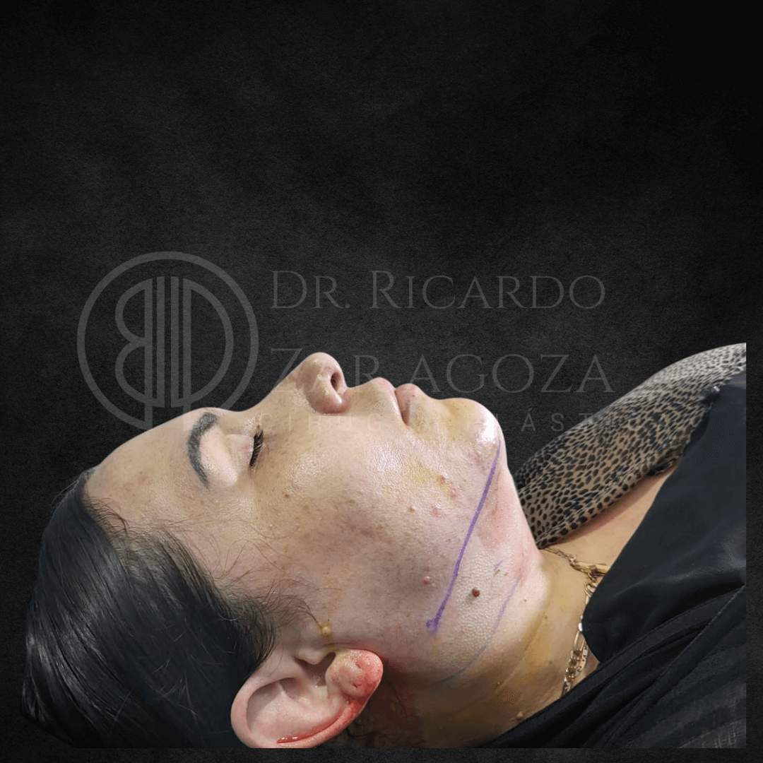 lipo papada