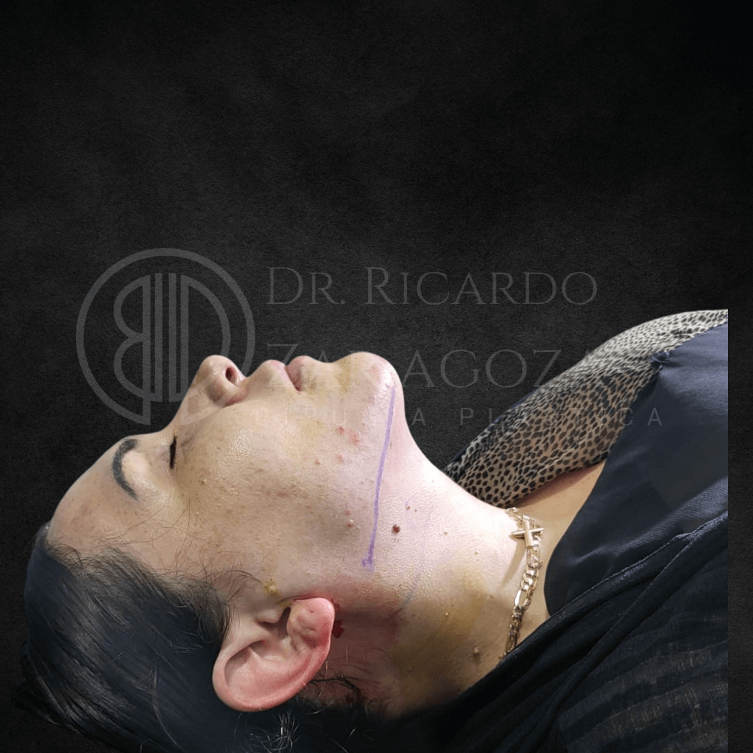 Lipopapada resultados precio liposuccion 1