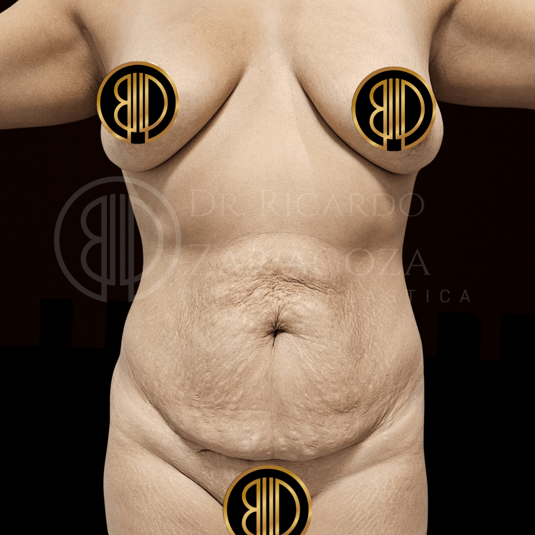 Mommy make over recuperar figura despues embarazo antes cirugia 1