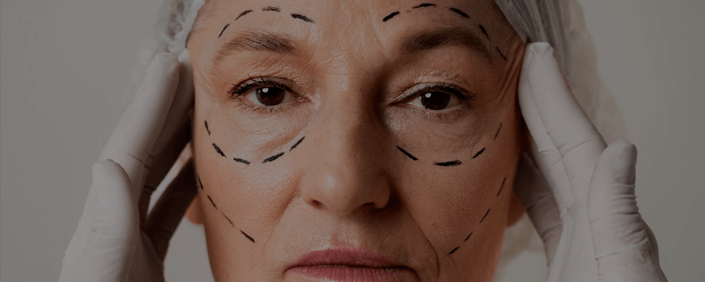 Facelift