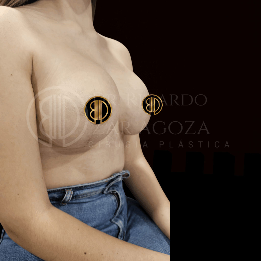 mastopexia levantamiento mamario con implantes despues2